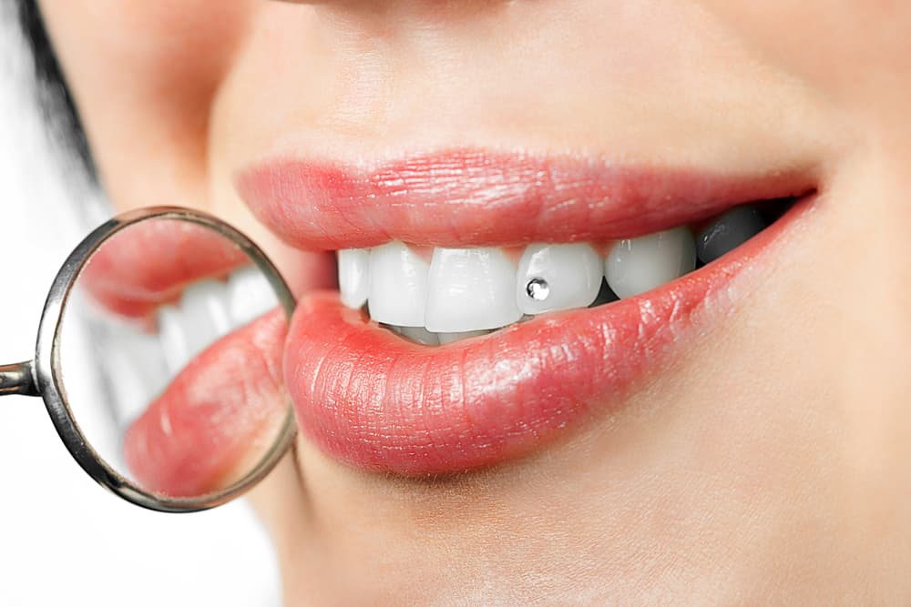 Dental Jewellery