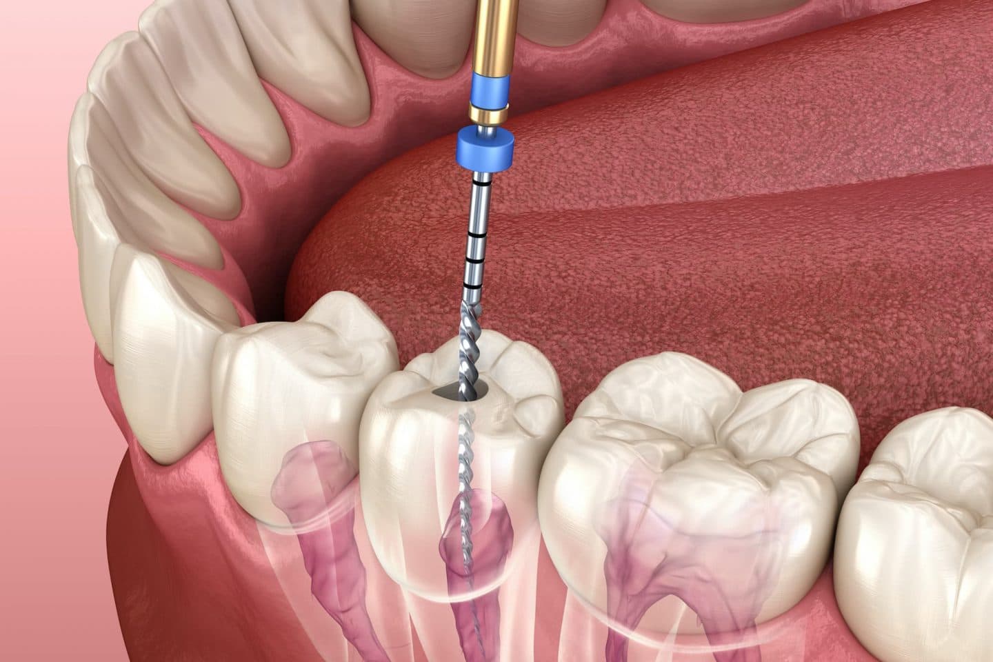 RCT (Root Canal Therapy)