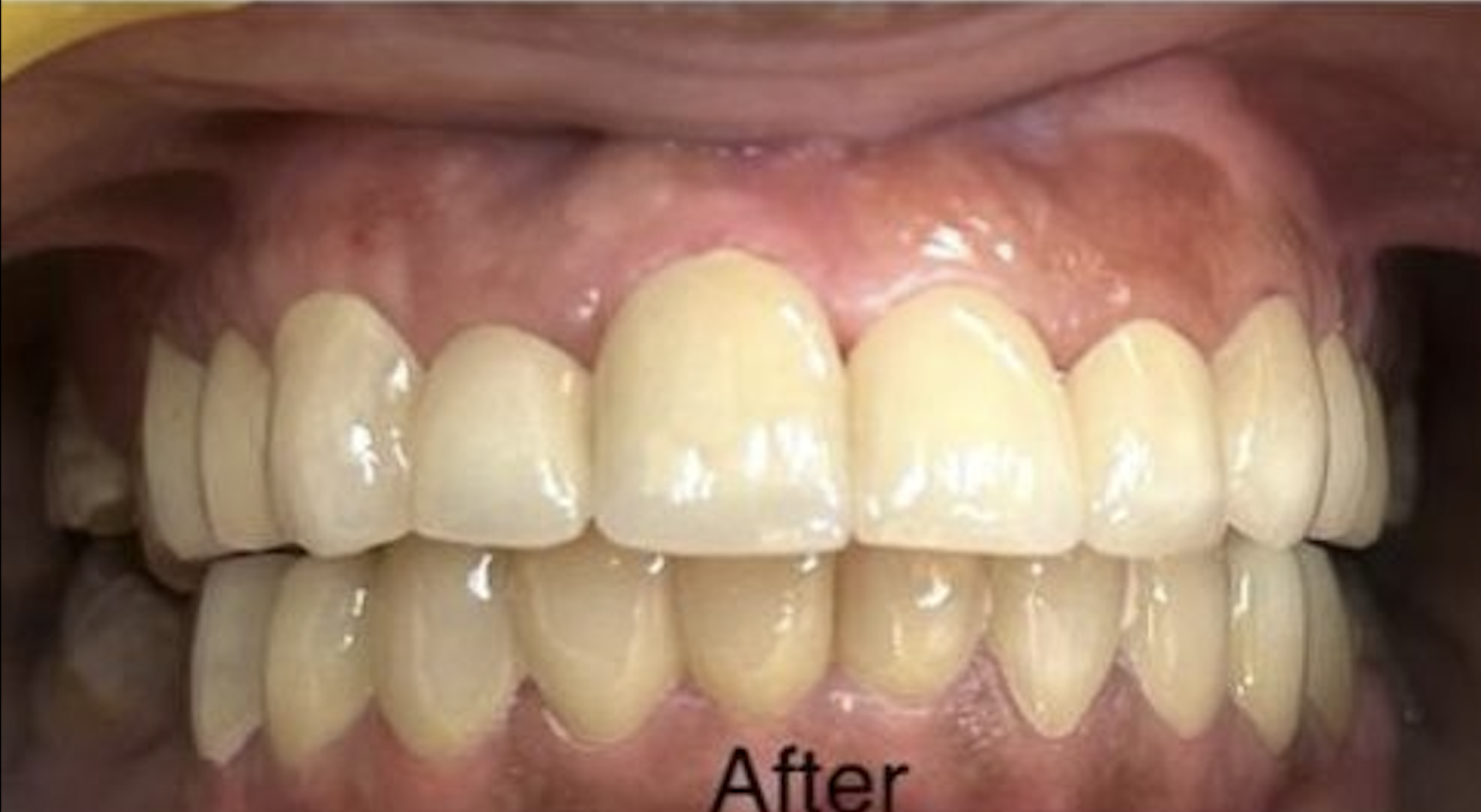 After Braces