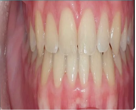 After Braces