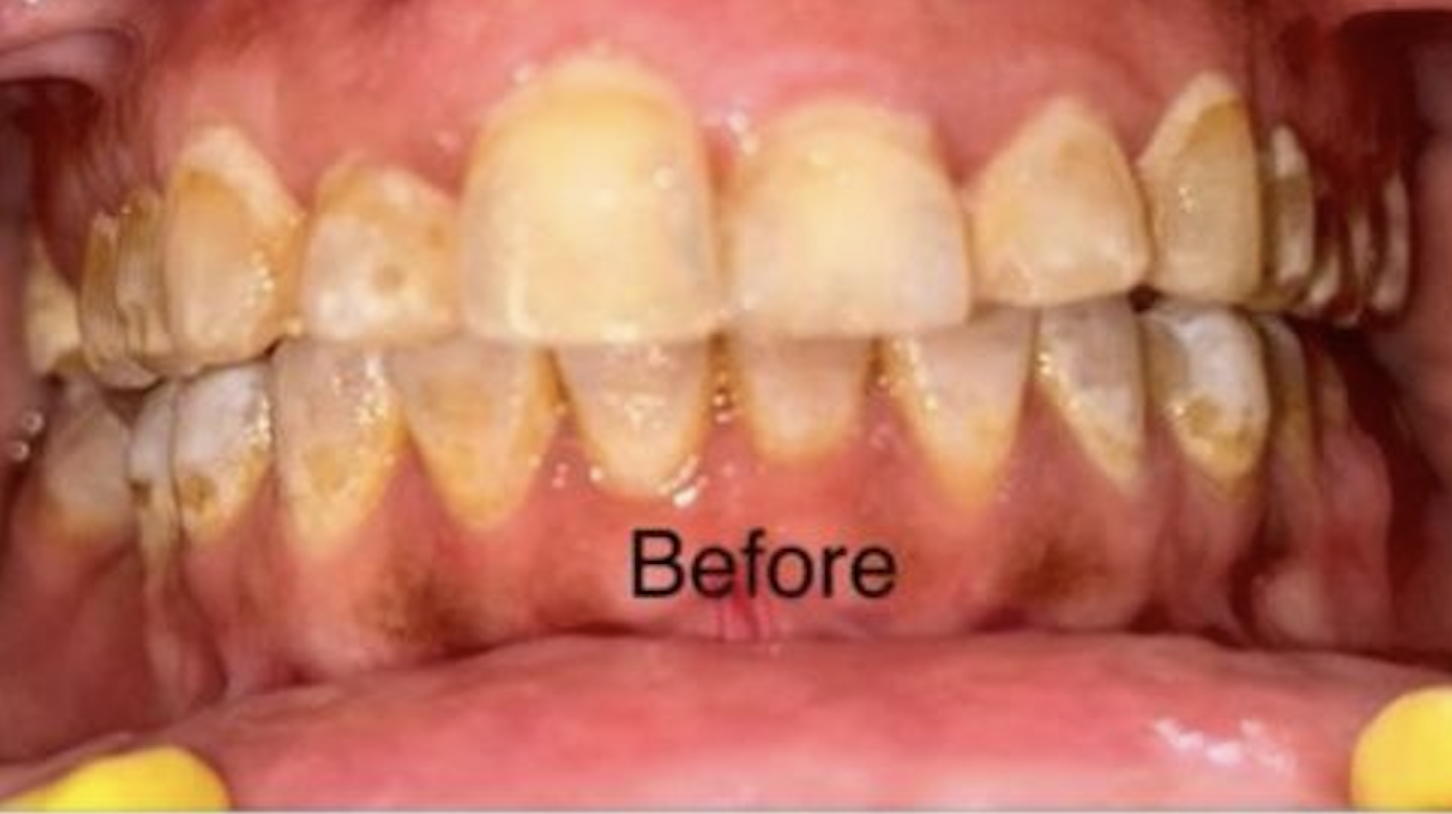 Before Braces