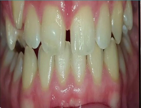 Before Braces