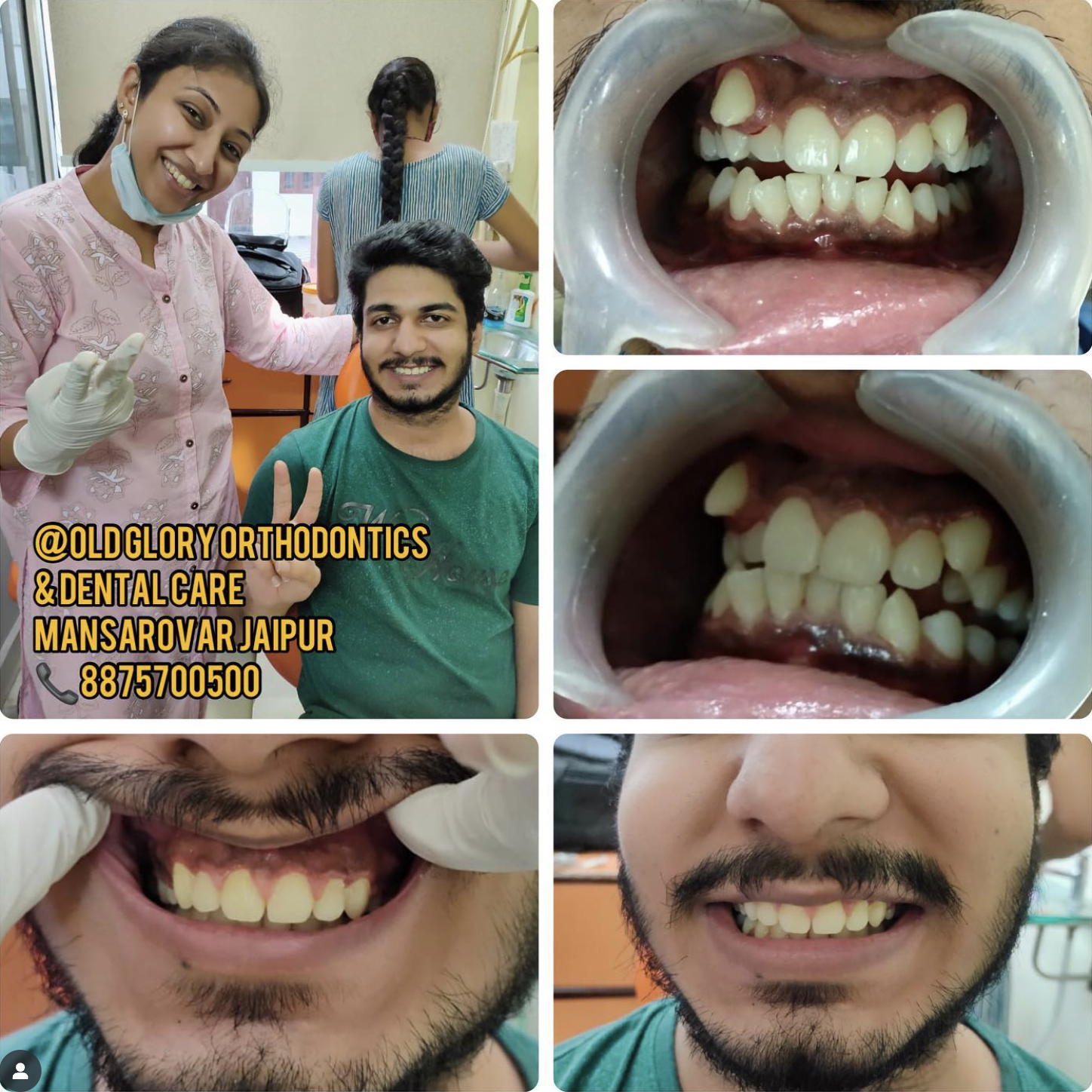 Teeth Whitening Results